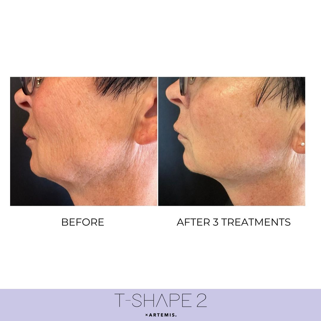 T-Shape 2 before and after — Neck Laxity & Lines, After 3 treatments