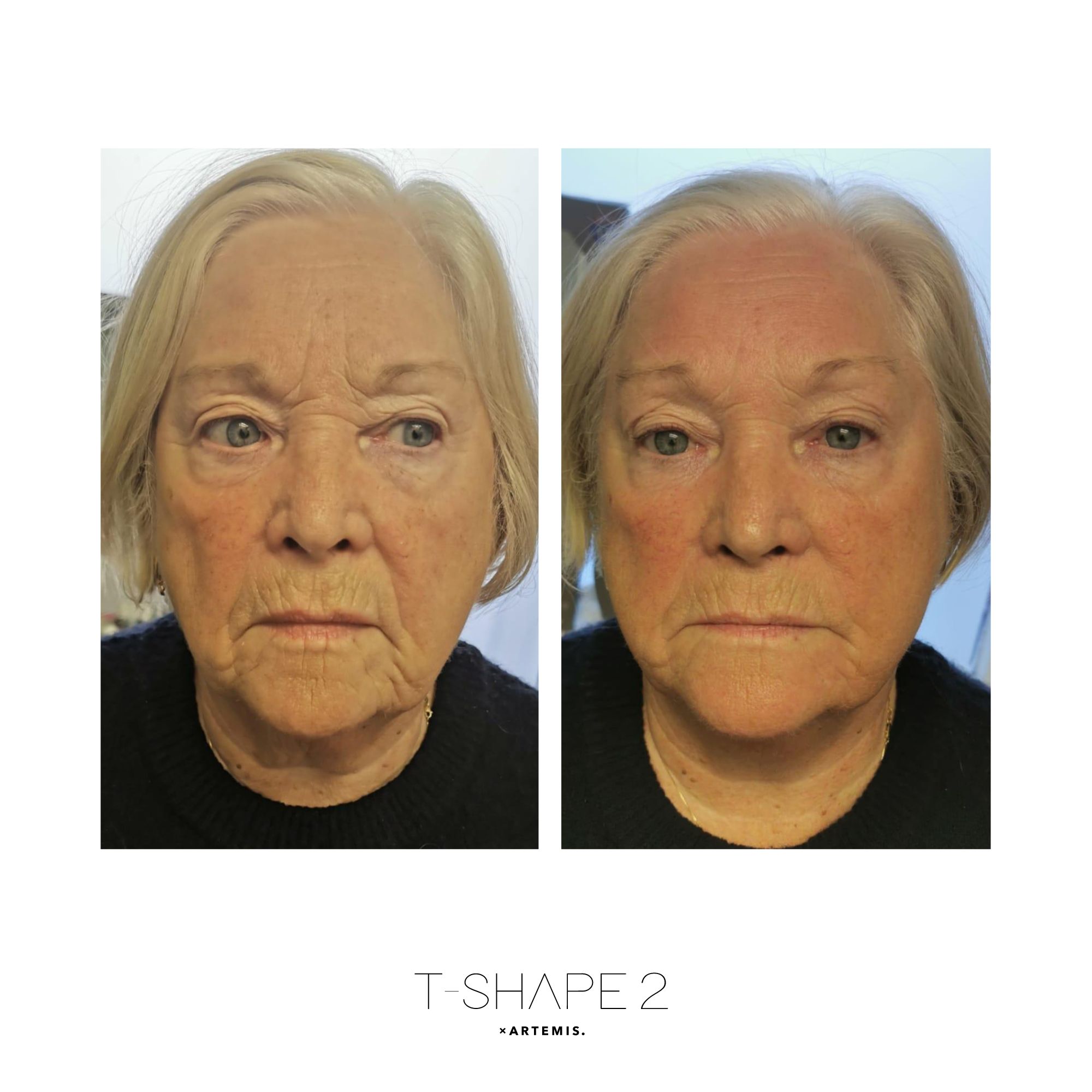 T-Shape 2 before and after — Full Face Rejuvenation, After 1 treatment