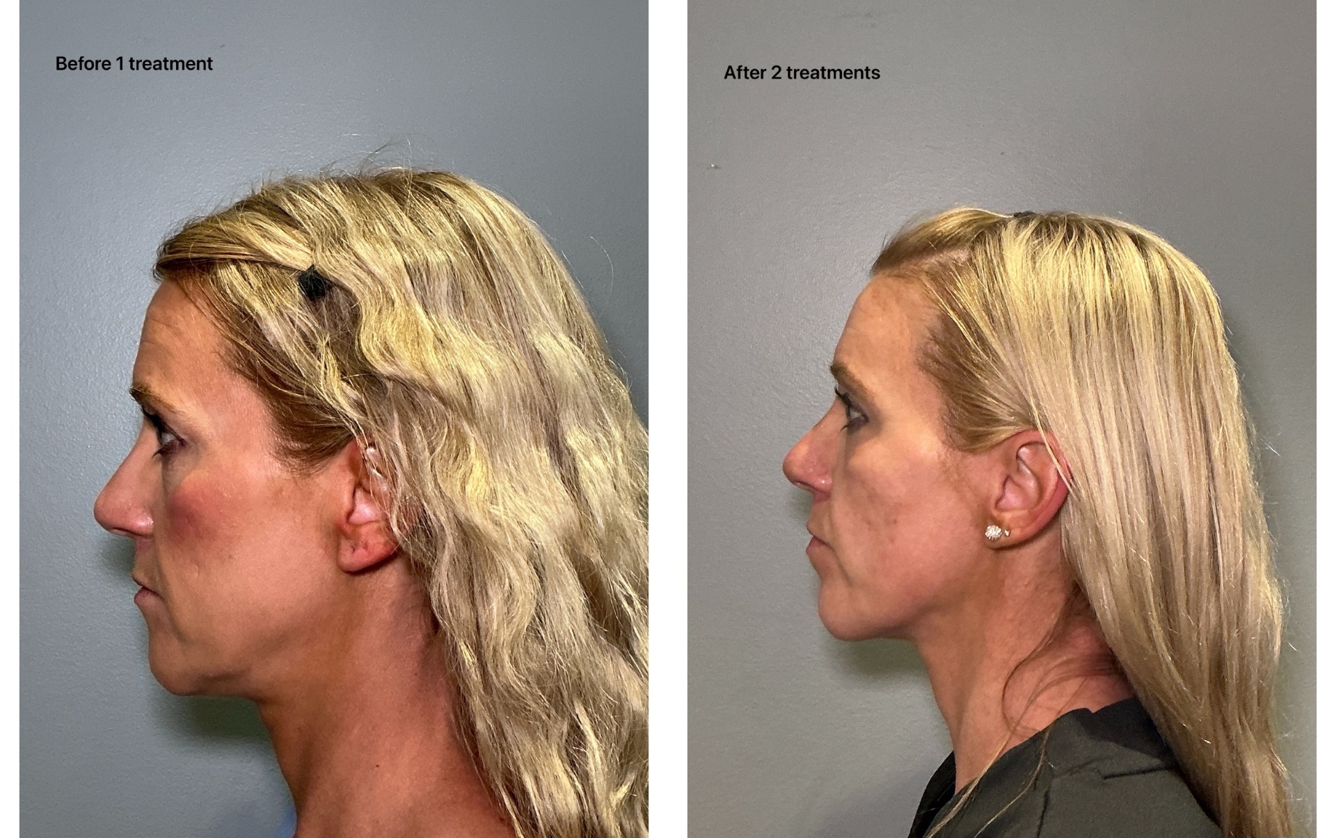 T-Shape 2 before and after — Jawline & Under-Chin, After 2 treatments
